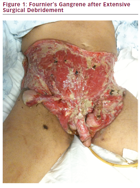 Extensive Fournier's Gangrene in a Patient with Type 2 Diabetes –  touchENDOCRINOLOGY