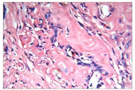 Figure 3: Thyroid amyloidosis hystopathology in patient 1