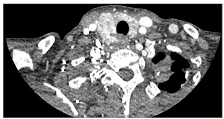 Figure 6: Computed tomography of the neck, case 3