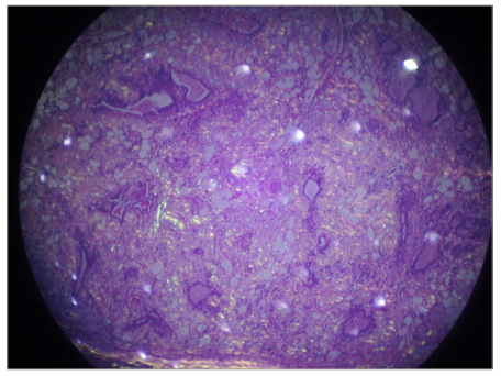 Figure 7: Thyroid amyloidosis hystopathology in patient 3