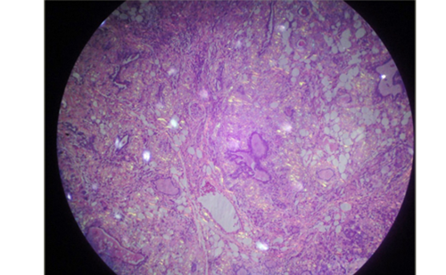 Figure 5: Thyroid amyloidosis hystopathology in patient 2